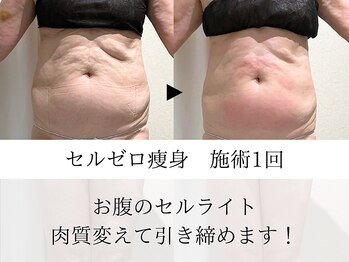 ウイ ネイルアンドビューティー(u'i nail&beauty)/1度で変わるセルライト♪