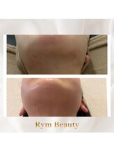 リム ビューティー(RYM BEAUTY)/インディバフェイシャル