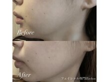 シェーン(Schon)/RFリフティング