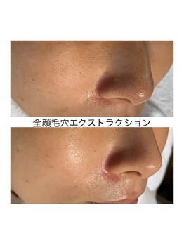 ウエカ(ueka)/お顔の隅々まで毛穴の掃除☆