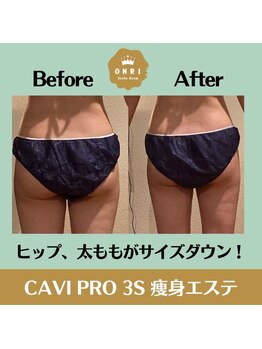 オンリ(ONRI)/太もも・おしり集中ケア