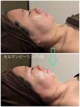 ラナ(Lana)/【セルマンピーリング】1回☆