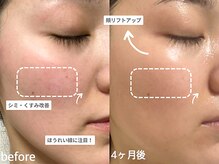 アンシャンテ 神戸元町店(Enchante)/毛穴洗浄ピーリングフェイシャル