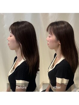 プライミー(PRIMY)/小顔矯正!ビフォーアフター