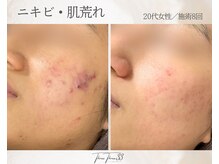 スリースリー(THREE THREE)/ニキビ・肌荒れ