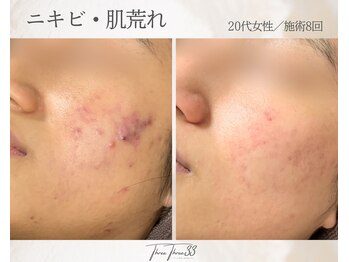 スリースリー(THREE THREE)/ニキビ・肌荒れ