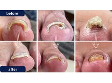 まき爪晴れる/貴方の大切な元の爪に戻ります。