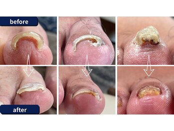 まき爪晴れる/貴方の大切な元の爪に戻ります。