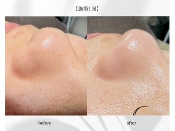 アン ビューティー(ann beauty)/施術1回【症例写真】20代