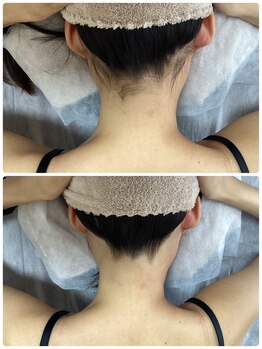 ルルトウキョウ 池袋店(LULU.tokyo)/うなじ脱毛