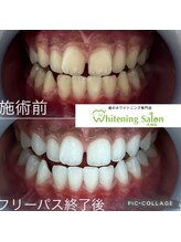 ホワイトニングサロン 札幌店/【ホワイトニング施術例】#札幌