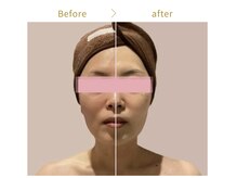 オレオール(aureole)/幹細胞培養上清液導入