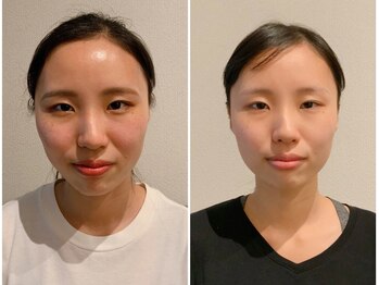 ソル(sol)/本格骨格小顔before→after