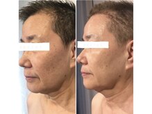 サンテボーテ(Sante Beaute)/ヒト幹細胞導入コース