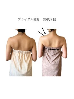 コーラル(Coral)/ブライダル痩身(施術結果)