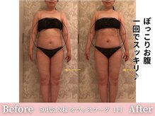 アメリイ 百合ヶ丘 新百合ヶ丘(Amerii)/【痩身】１回でお腹をスッキリ！