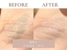 サエラ(SAERA)/脇脱毛【3回】