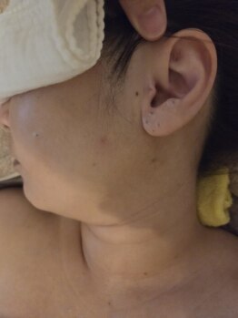 ローズムーン(Rose.Moon)/耳つぼシール