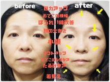 コルギbefore after/少しずつ骨格が上がり#小さくなります。