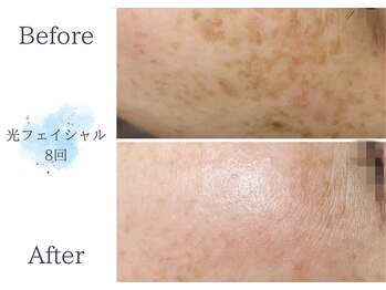 ディアスマイル(Dear.smile)/光フェイシャル8回