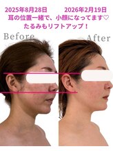 アファン 鶴見店(Afun)/【30代小顔】ほうれい線スッキリ