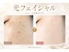 【光フェイシャル】シミ・くすみ改善コース ¥6,000