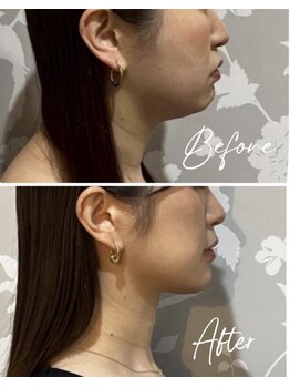 カラット(CARAT)の写真/【韓国小顔美容】話題のレッドショット導入◎お顔のたるみケアで、引き締まった憧れのフェイスラインへ♪