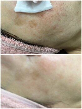 メンズアンドレディース エステティックサロン ティアラ(TiaLa)/気になるシミも♪