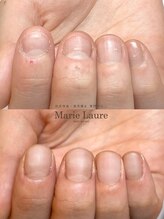 マリーロール 梅田店(Marie Laure)/自爪育成/深爪矯正/ネイルケア