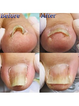 巻き爪補正店 湘南辻堂店/巻き爪・補正例