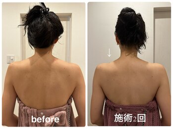 アモリール(Amolir)/ブライダル痩身2回