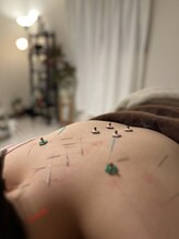 ハリキュア(Hari-Cure)/鍼とお灸のトリートメント