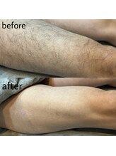 ヴィシアス(VIXIAS)/脱毛　施術1回　2ヶ月後