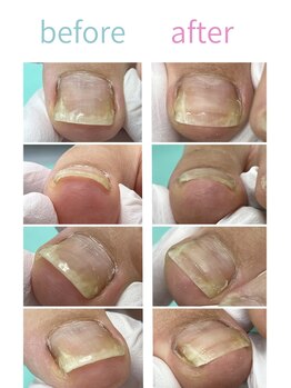 巻き爪補正店 富山店/巻き爪