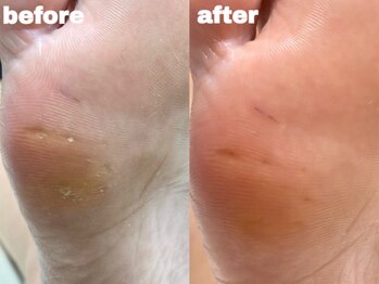 サゥオルサロン(sawalsalon)の写真/素足になっても自信をもてる美しい足元に導きます♪角質肥厚・タコ・魚の目などのお足のお悩みを解消◎