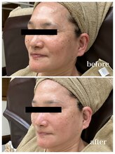 ジャスミン(Jasmin)/臍帯血幹細胞×NMN×AC-11