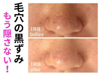 エリン(ERIN)/毛穴徹底洗浄　１回目