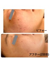 リボーテ(Re-Beaute)/エルモサハーブピーリング