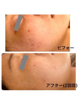 リボーテ(Re-Beaute)/エルモサハーブピーリング