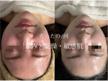 オーシャンブルーム 目黒(OceanBloom)/赤み乾燥敏感肌