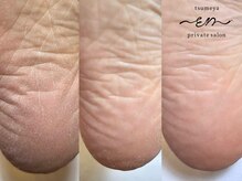 かかとの角質ケア◎1日でここまで綺麗になれますよ♪