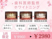 歯のホワイトニング 岐阜アクティブG店