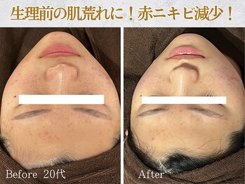 ぷるる 練馬 江古田/20代 ララピール+ゲルマスク