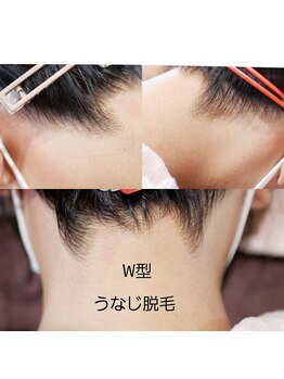 アイシェリー(eyecherie)/人気うなじ脱毛 W型