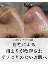 ヨハク 市川店(yohaku) 角栓の悩み 毛穴洗浄