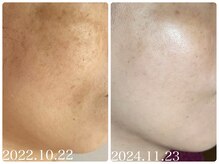 フォーチューン/モヤモヤジミの改善ケア