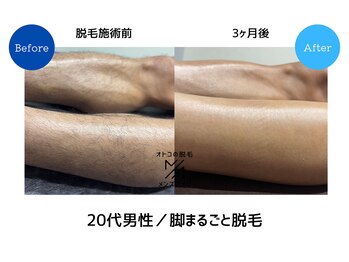 メンズアメリ/高知/メンズ脱毛/ヒゲ/全身/VIO