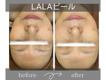 サロンドボーテアリス (Salon de beaute ALICE)/肌を育てるLALAピール