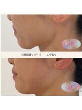 トリートメントルーム フェリーチェ(Felice)/気になってたエラ張りもスッキリ