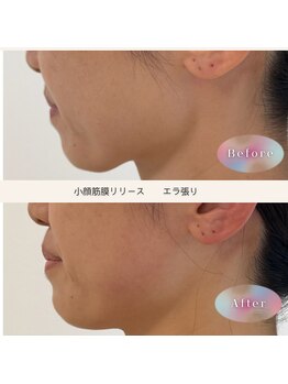 トリートメントルーム フェリーチェ(Felice)/気になってたエラ張りもスッキリ